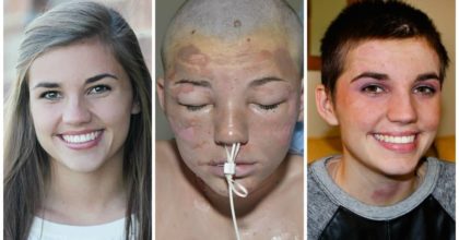 Burn Victim adjudged as Prom Queen. This is Uplifting