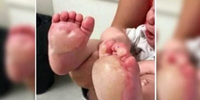 Babysitter arrested for child abuse after the mother comes home and discovers huge blisters on her baby’s feet. Babysitter arrested for child abuse after the mother comes home and discovers huge blisters on her baby’s feet.