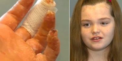 Girl suffers from third-degree burn after playing with slime. Girl suffers from third-degree burn after playing with slime.