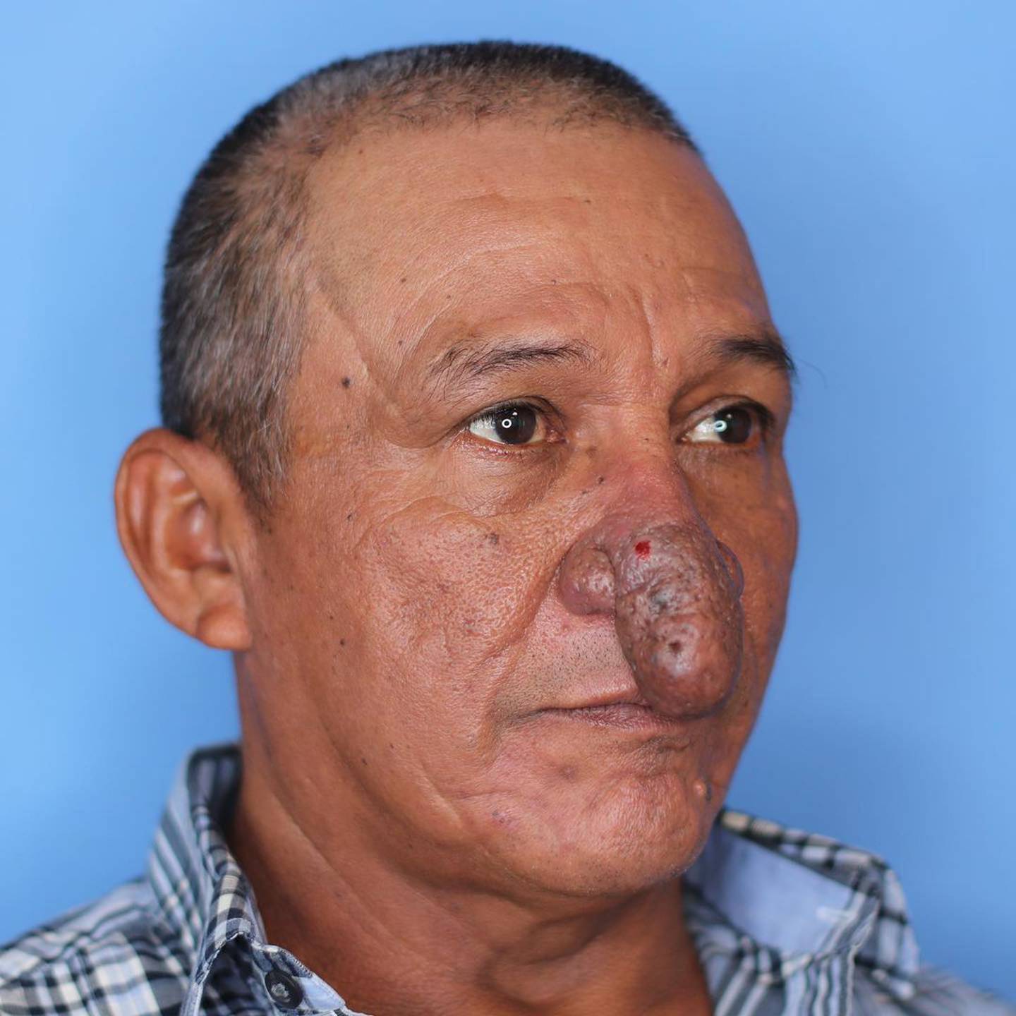 Painter Conrado Estrada was suffering from Rhinophyma. Photo / Dr Thomas Romo III/Instagram