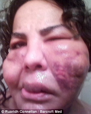 Disastrous results: Rajee's face was left with golf ball-sized balls of cement in her face, which she had been living with for more than a decade