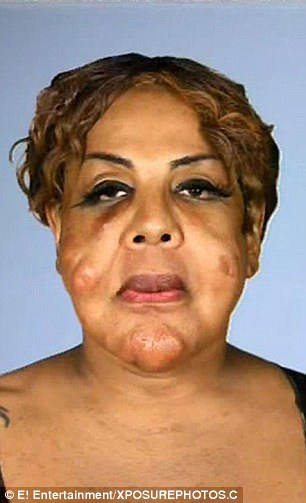 Amazing transformation: Rajee Narinesingh had cement nodules removed from her face a decade after she had black market injections that left her disfigured. Rajee is pictured before her surgeries