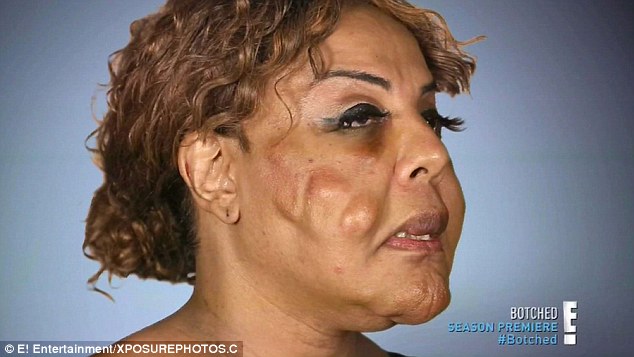 Life-changing: The 48-year-old transgender woman from Hollywood, Florida, received harmful injections made up of cement and tire sealant in her cheeks, chin, and lips at a 'pumping party' in 2005 
