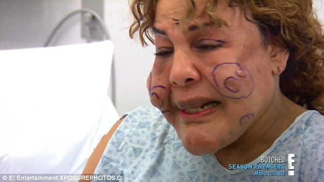 Preparation: Dr. Dubrow circled the nodules on Rajee's face that he wanted to remove during the procedure 