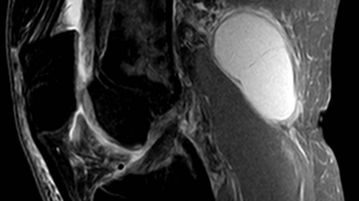 mri image of a baker’s cyst
