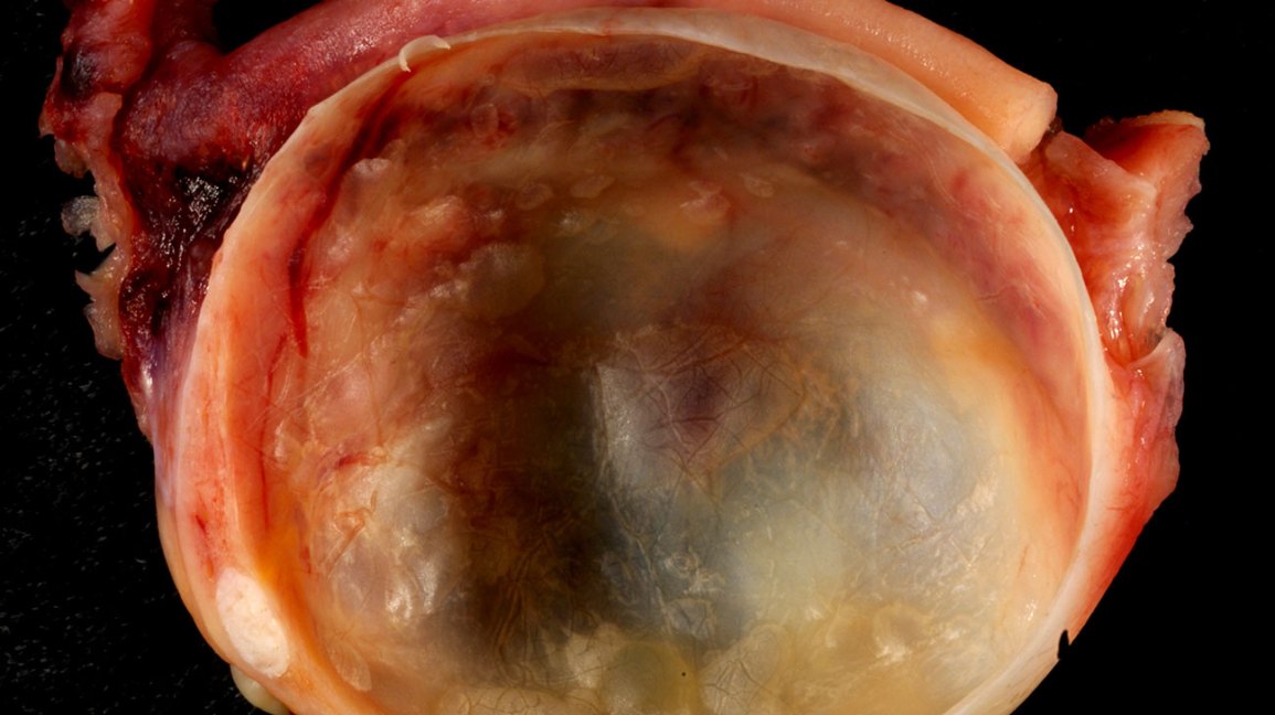 close-up of an ovarian cyst