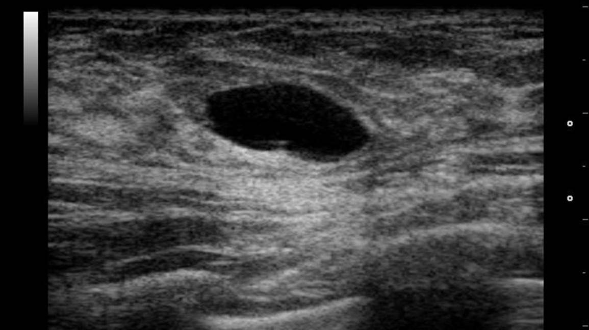 ultrasound image of a breast cyst