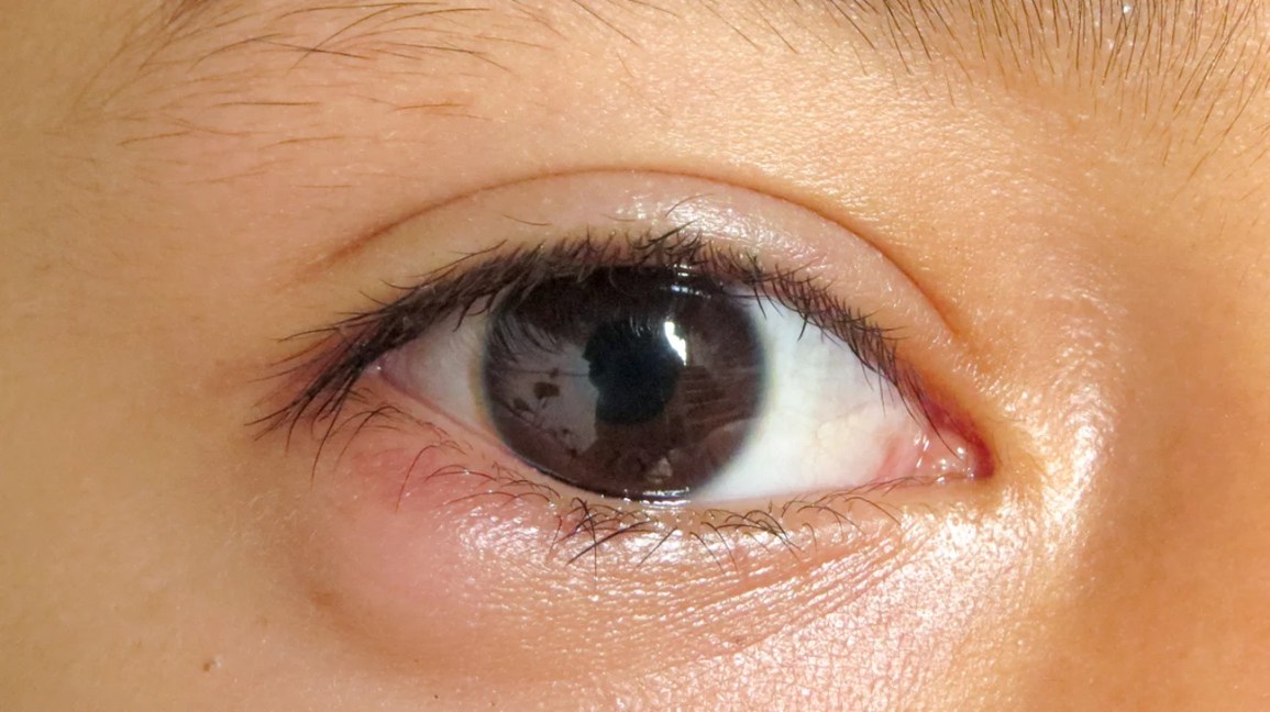 close-up of a right eye with a chalazion on the lower eyelid