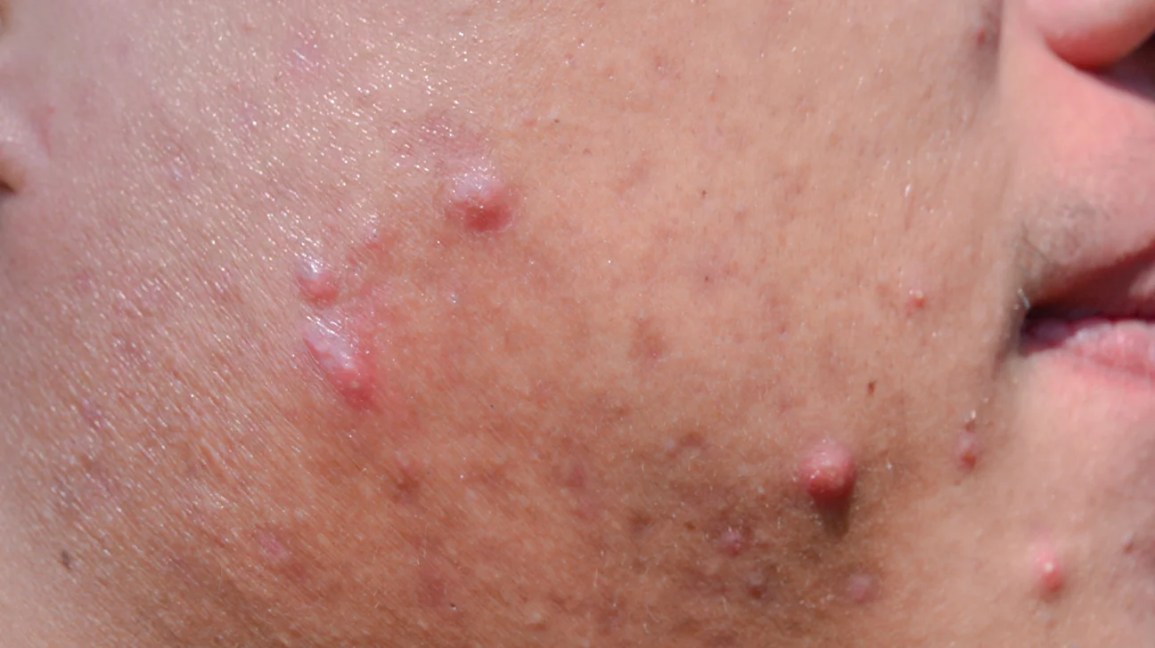 close-up of cystic acne bumps on the right cheek of a young man