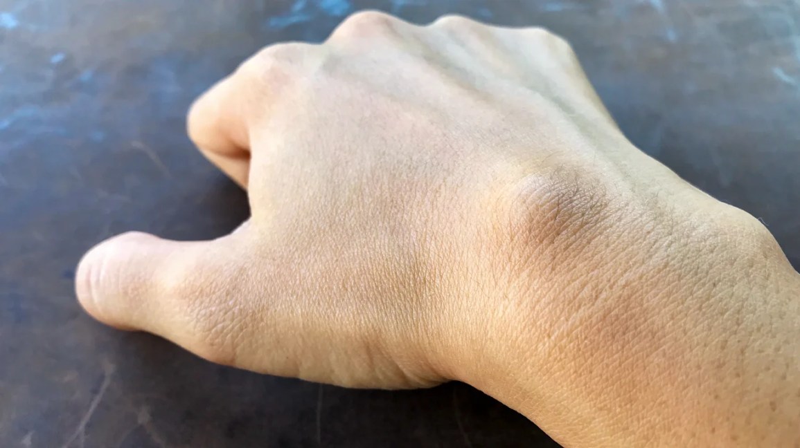 close-up of a ganglion cyst on the top of the right wrist