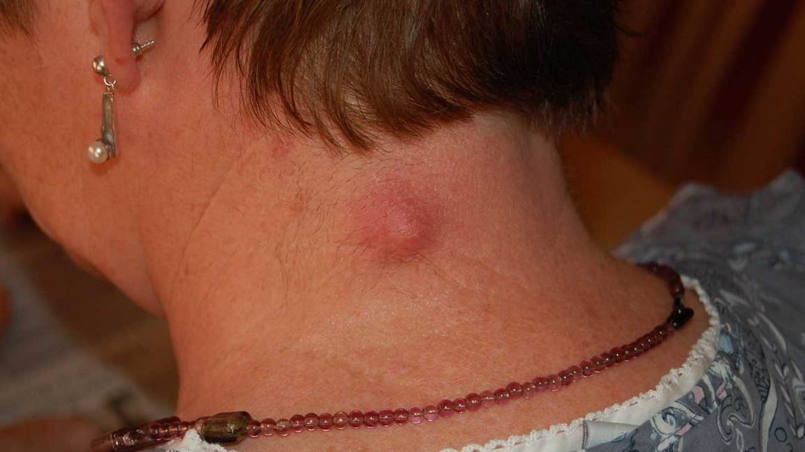 close-up of an epidermoid cyst on the back of the neck