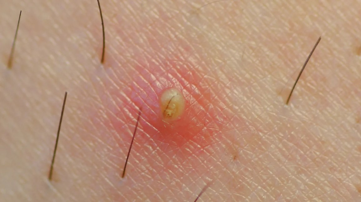 close-up of an ingrown hair cyst