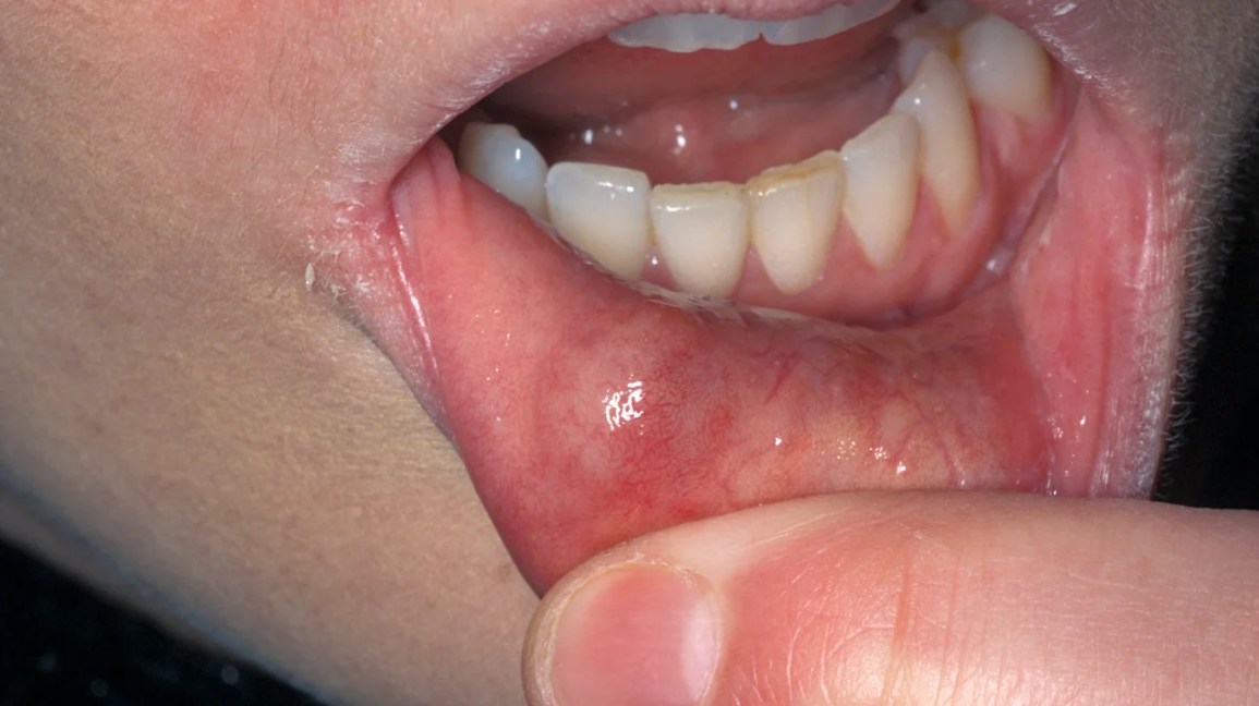 close-up of a mucous cyst on the inside of the lower lip