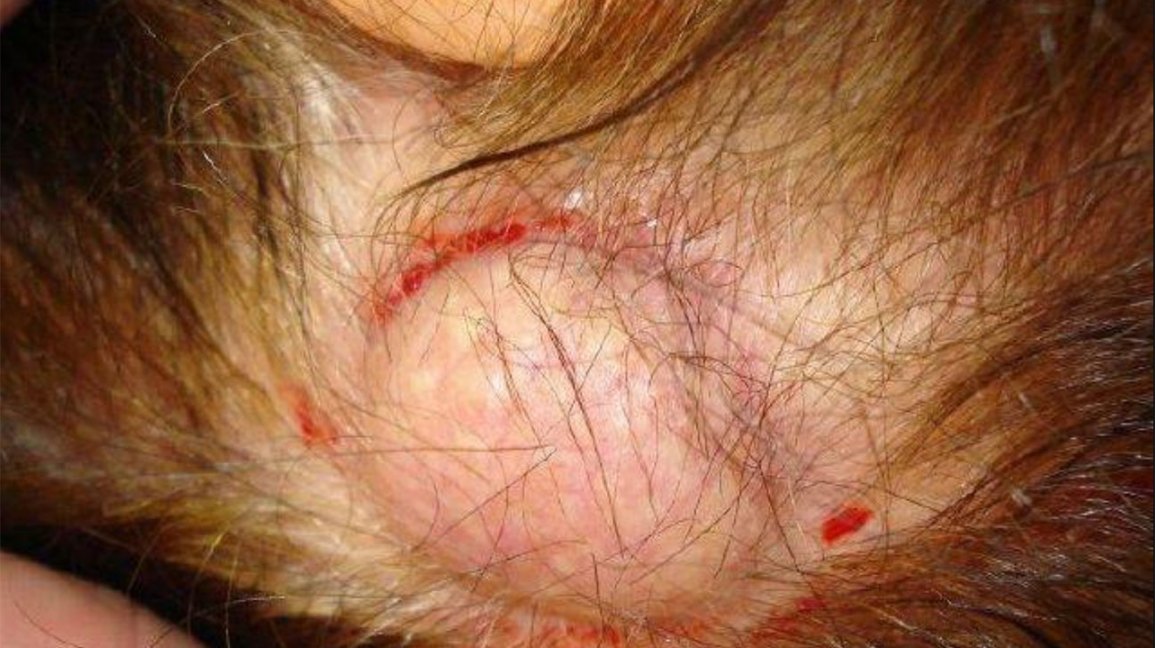 close-up of a pilar cyst on the scalp