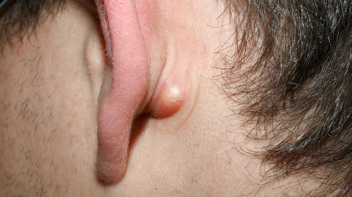 close-up of a sebaceous cyst behind the left ear