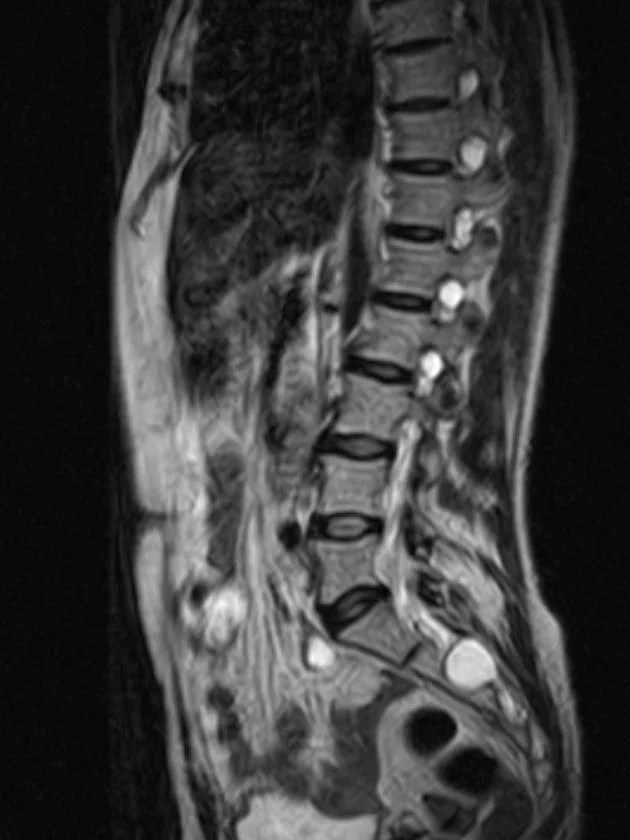 mri image of perineural cysts on the spine